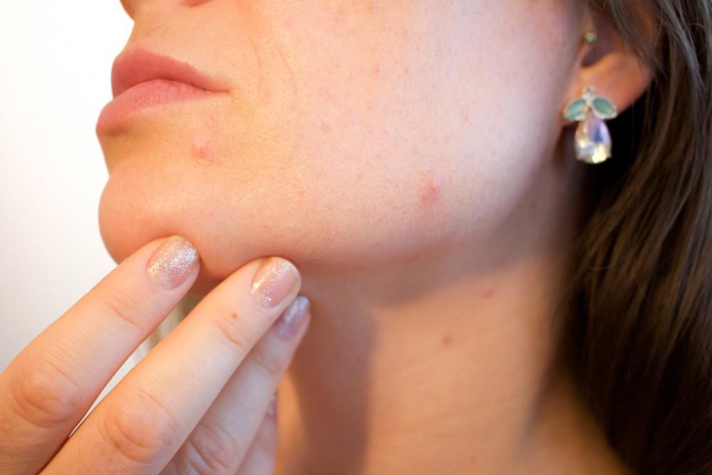 inspection of a woman's acne scars around the jaw