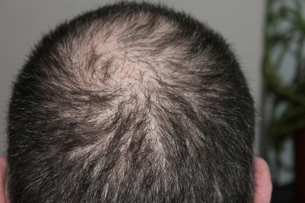 man's bald spot on the back of his head
