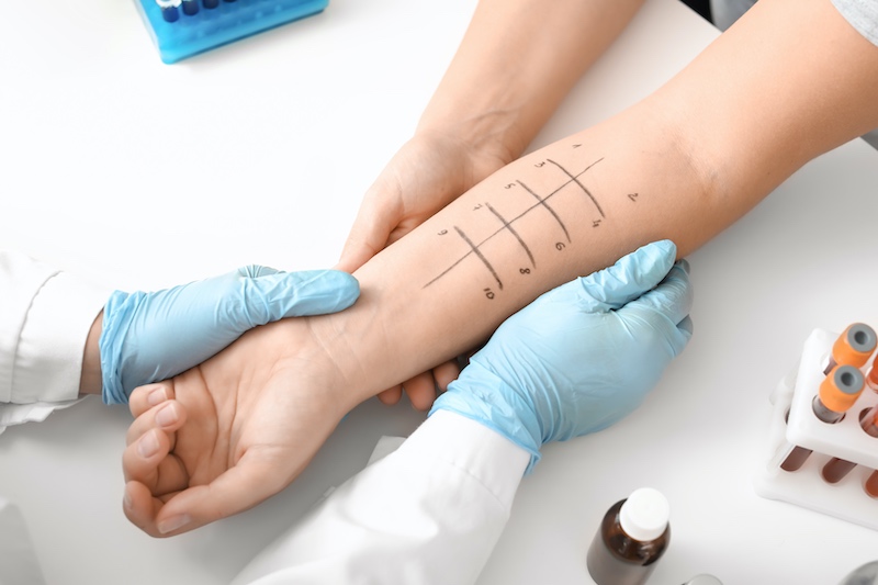 allergy skin test panel on the forearm