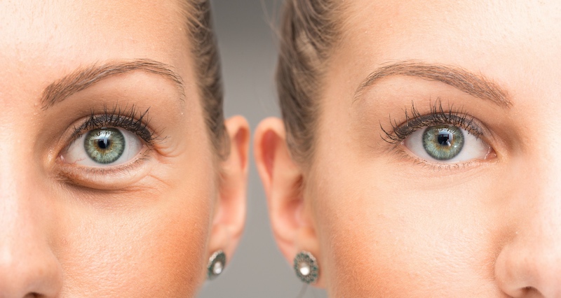 Eyes of woman before and after botox